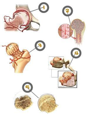 最新股骨头坏死治疗方法的研究与应用及其成效